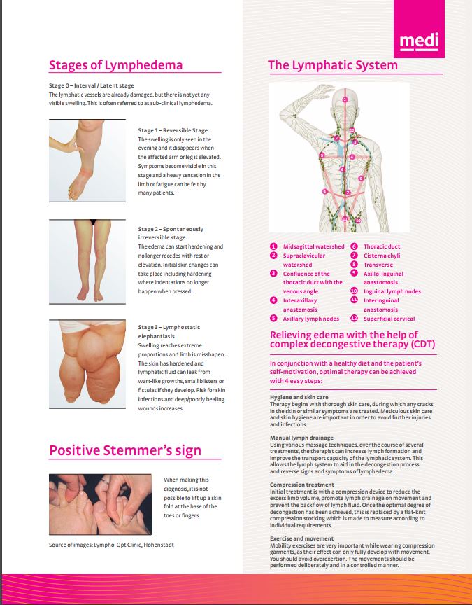 LYMPHEDEMA OVERVIEW FLYER